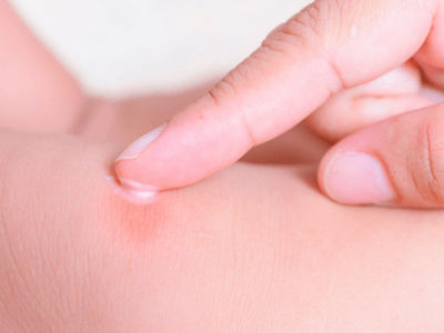 como aliviar picadura de mosquito tigre